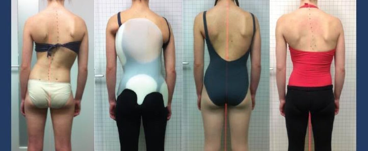 ScoliBrace for Adults: Enhancing Mobility and Quality of Life