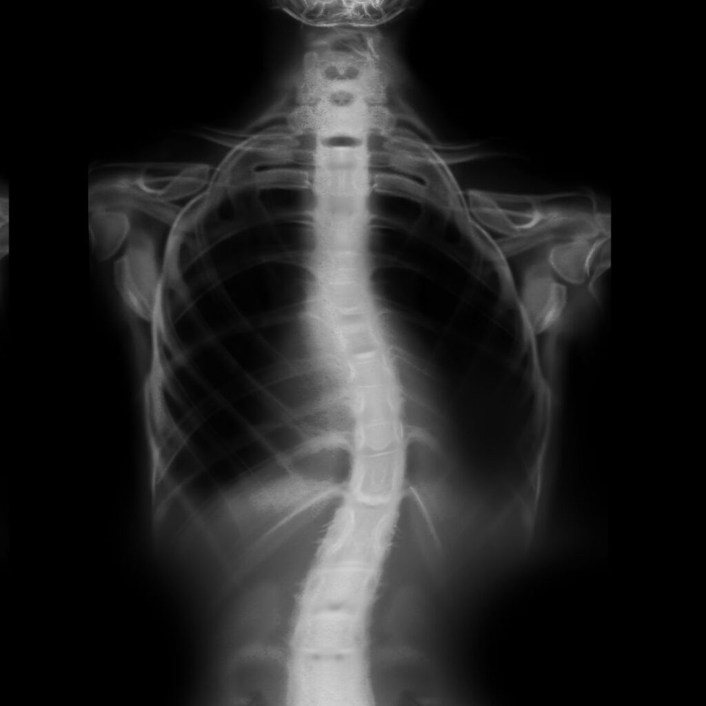 Scoliosis Treatment in Toronto