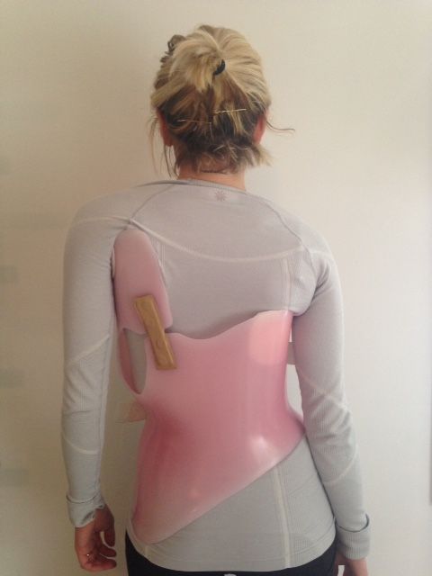 mild scoliosis treatments